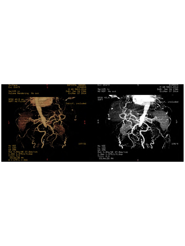 AKI Secondary to Complete Abdominal Aortic Occlusion