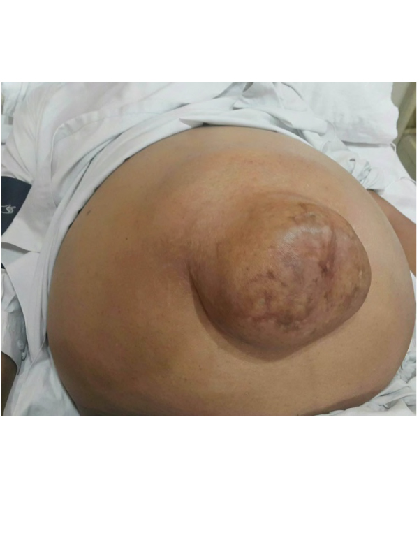 Marked Abdominal Ascites with Supraumbilical Hernia