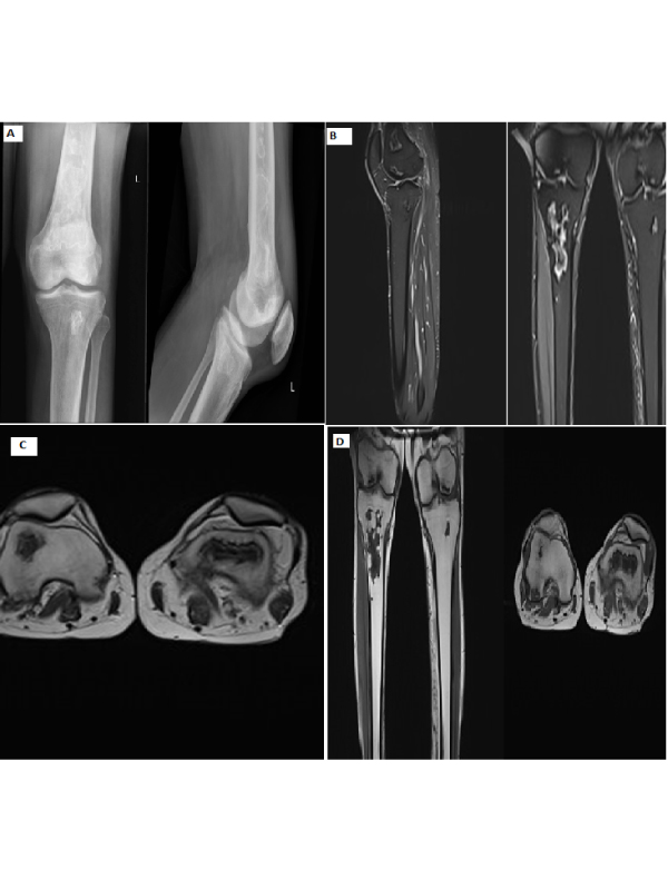 Multifocal Osteonecrosis in Systemic Lupus Erythematosus