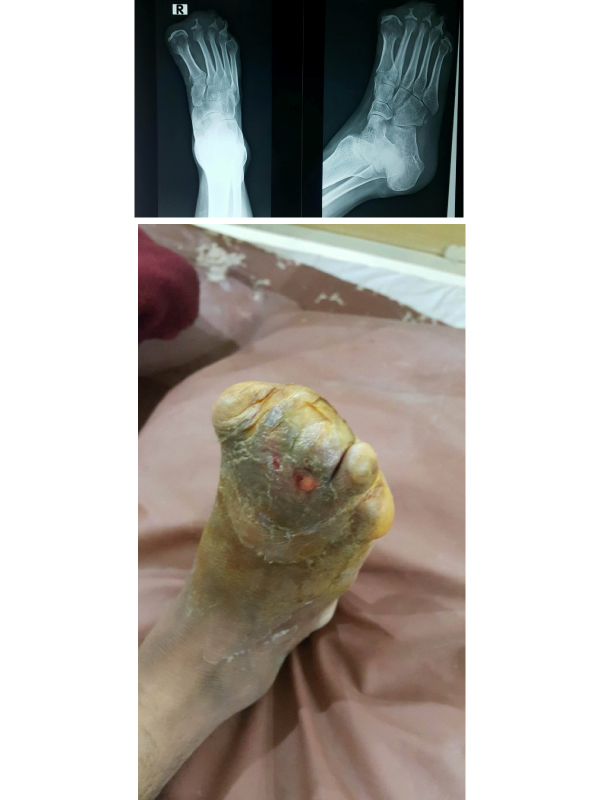 Auto Amputation of four Toes after Traumatic Great Toe Amputation
