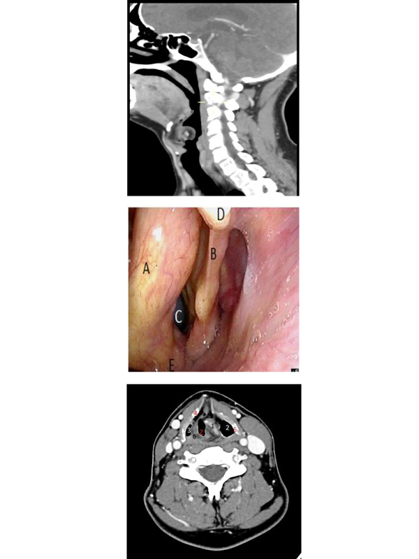 A Careful Preoperative Airway Assessment