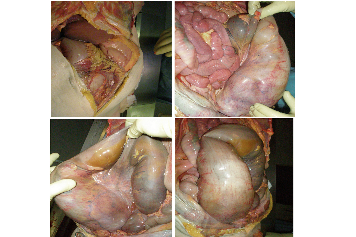 Faecal Impaction with Deadly Outcome