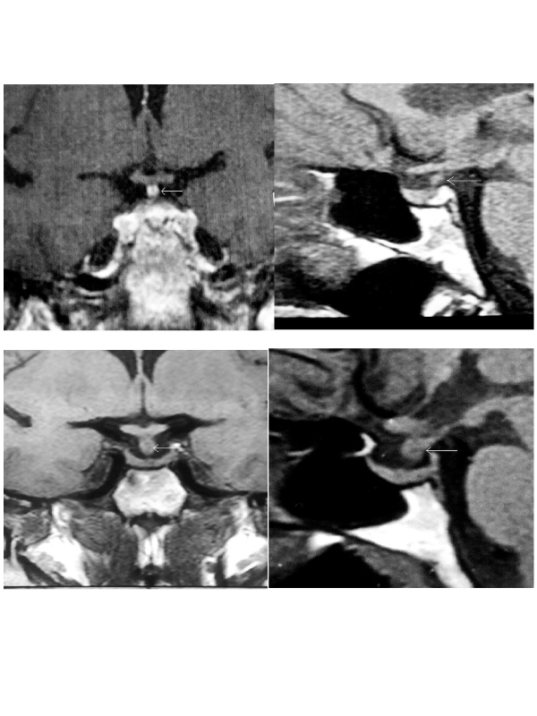 Pituitary Stalk Thickening