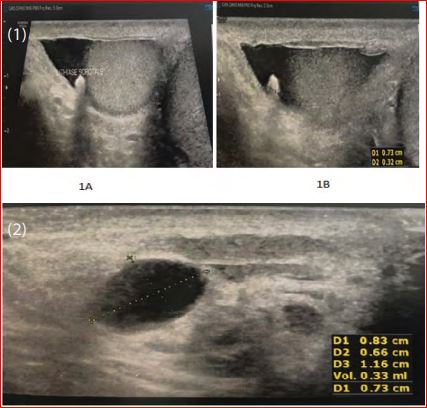 Scrotal Calculi: A Rare Ultrasonography Finding