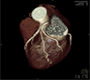 Asymptomatic  Marathon Runner with Silent Myocardial Ischemia due Coronary Artery Disease for Proximal LAD Stenosis