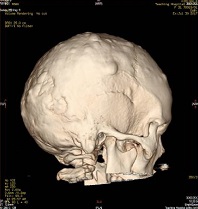 External Manifestations of Gardner?s Syndrome as the Presenting Clinical Entity
