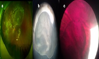 Ocular Cysticercosis