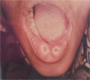 Paramedian Lip Pits