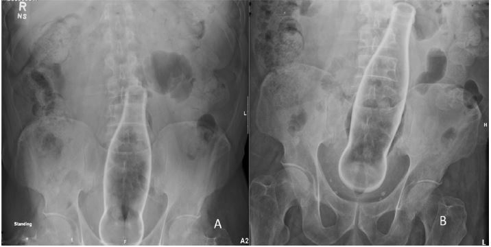 Retained Colorectal Foreign Body: A Case Report