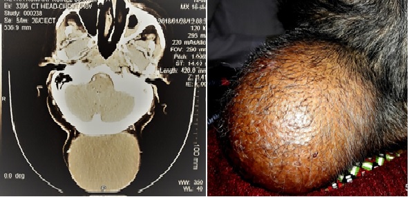 Huge Occipital Mass in Elderly Female