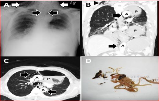 Boerhaave's Syndrome: Spontaneous Esophageal Perforation