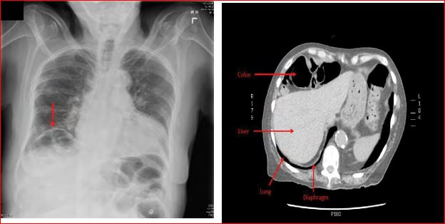 Chilaiditi's Sign and Abdominal Pain: Chilaiditi's Syndrome