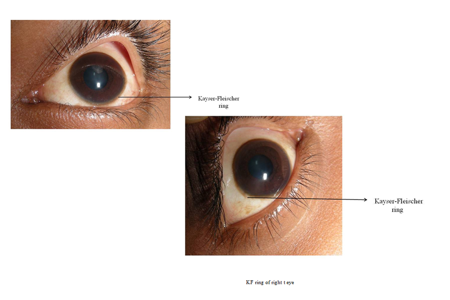 Wilson’s disease