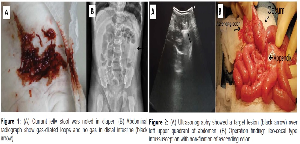 Waugh's Syndrome: A Rare Presentation of Intussusception