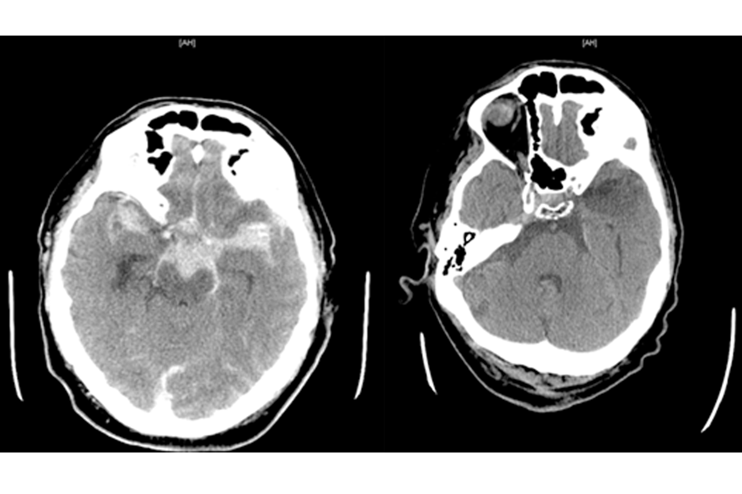 Traumatic Subarachnoid Hemorrhage and Contusion