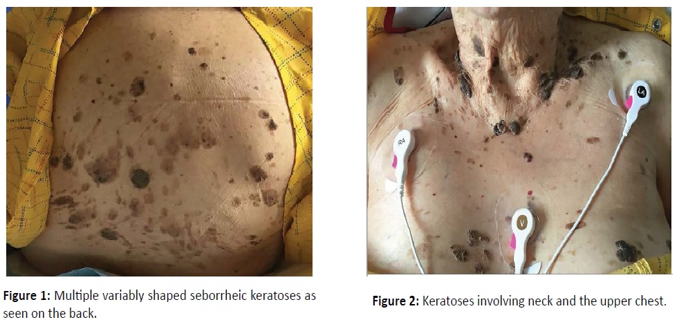 Leser - Trelat Sign in Adenocarcinoma of Gallbladder
