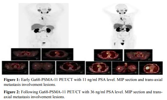 Ga-68 PSMA-11 PET in Progressive Prostate Cancer