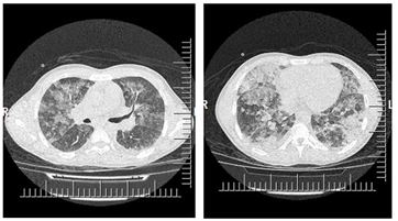 Acute Eosinophilic Pneumonia Due To Cocaine Inhalation