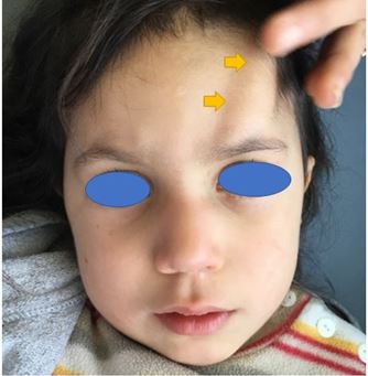 A Supraorbital Tumefaction in the Child