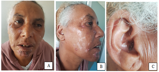 Rare Variant of Chronic Lupus Erythematosus: Comedonian Lupus