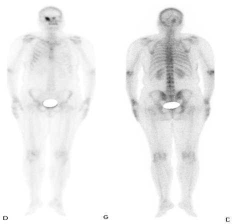 Single Orbital Bone Metastasis of Infiltrative Breast Carcinoma in Adults: Interest of a 3-Fields of View Bone SPECT-CT Acquisition
