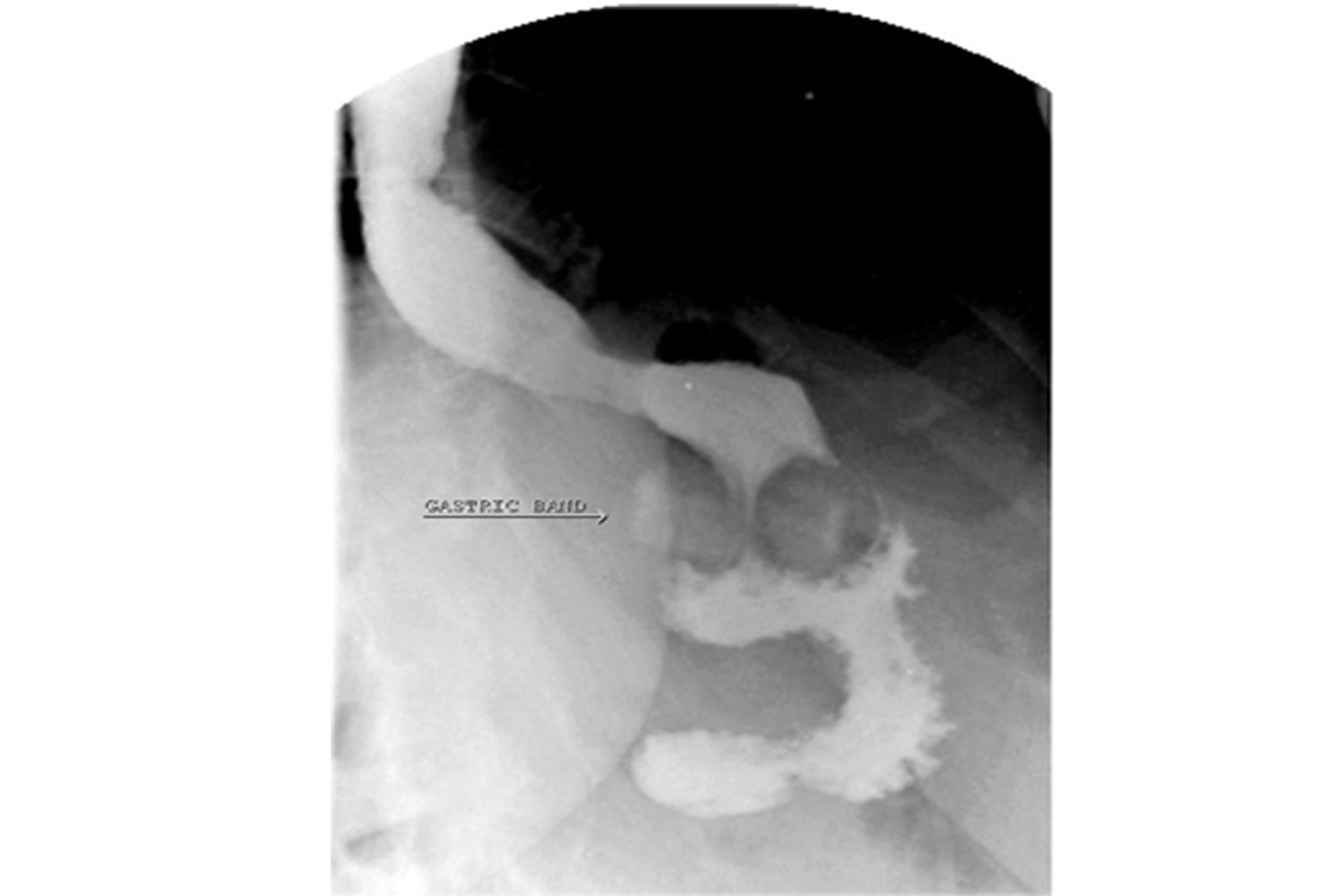 Anterior Slip of an Adjustable Gastric Band