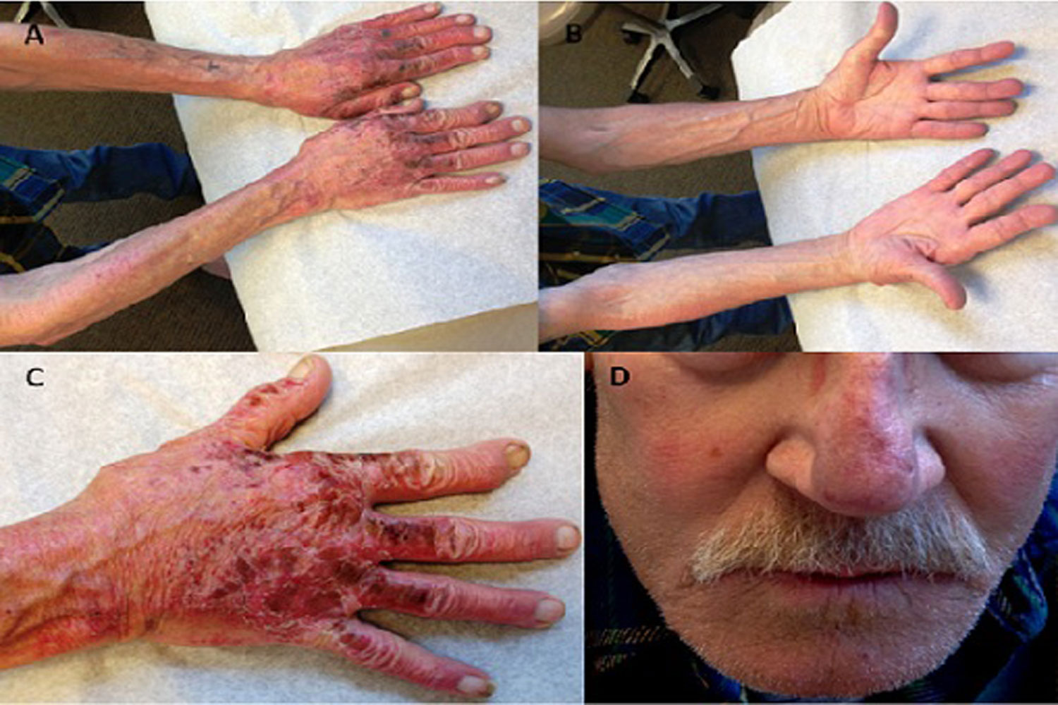 Rash on Sun Exposed Areas of Skin