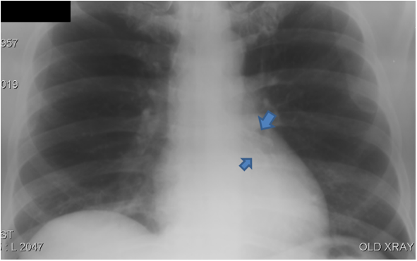 Coronary Calcium on Chest X-Ray
