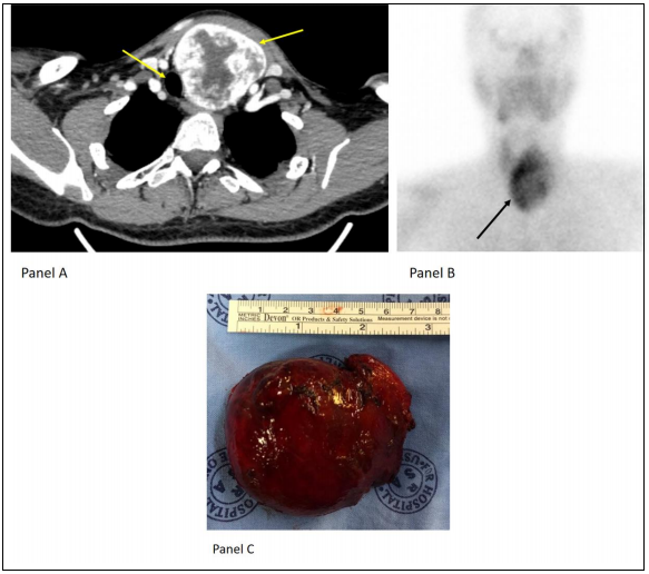 Acute Airway Obstruction due to a Benign Thyroid Mass