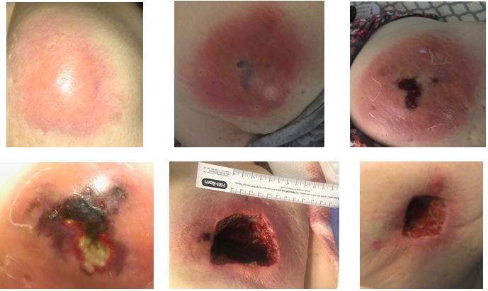 Necrotizing Fasciitis Following Intramuscular Self-Injection of Insulin