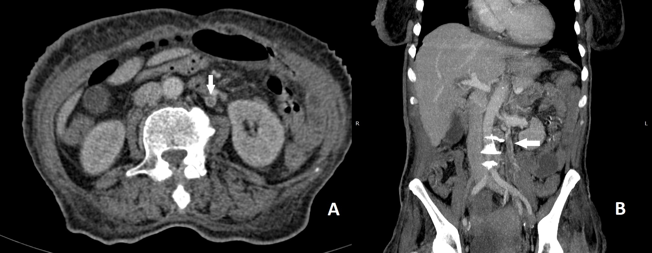 Ovarian Vein Thrombosis