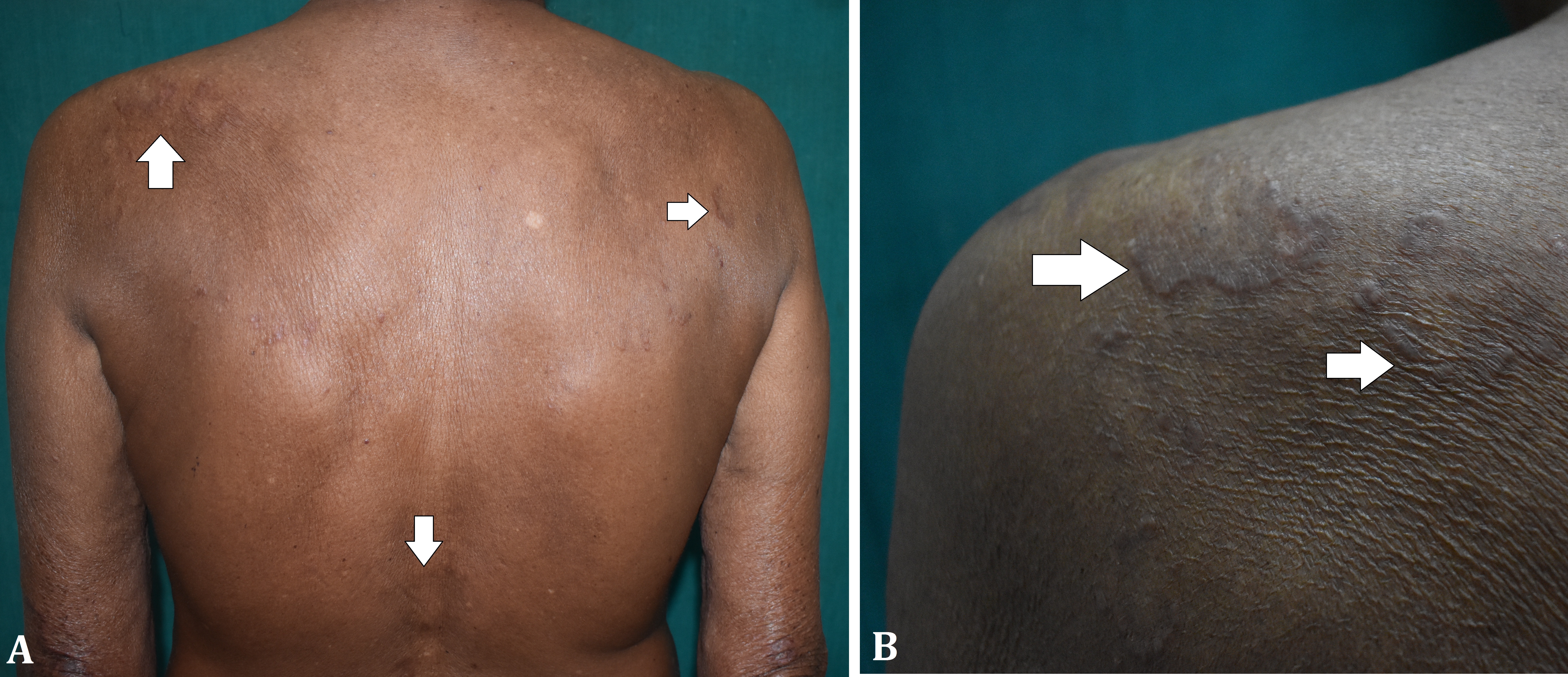 Granuloma Annulare Masquerading as Hansen's Disease and Showing Reverse Koebner Phenomeno