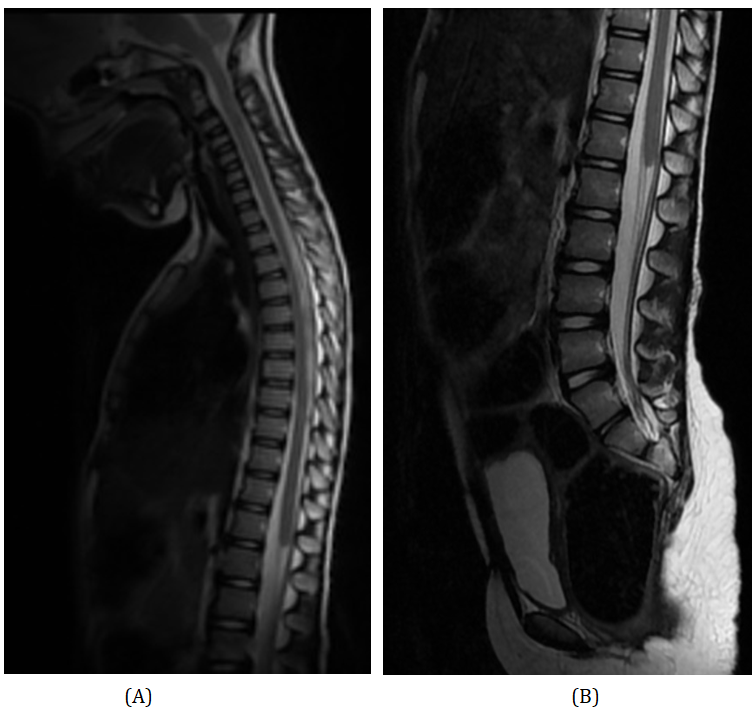 Caudal Regression Syndrome