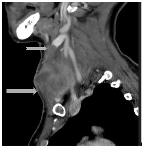 Lemierre's Syndrome: A Rare yet Fatal Complication of Dental Abscess