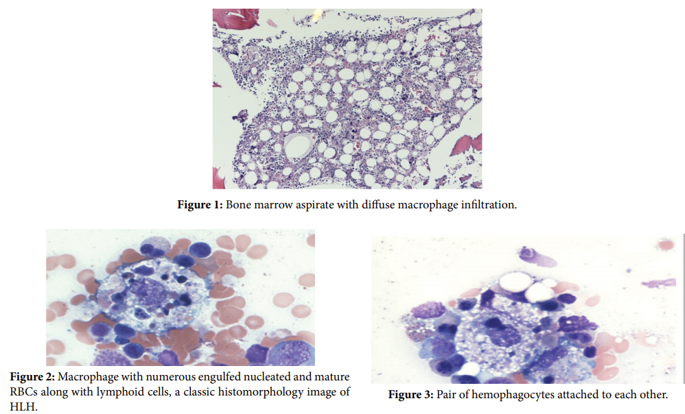 Hemophagocytosis Secondary to Sars-CoV-2 in a Young Patient Presenting
with Acute Liver Failure