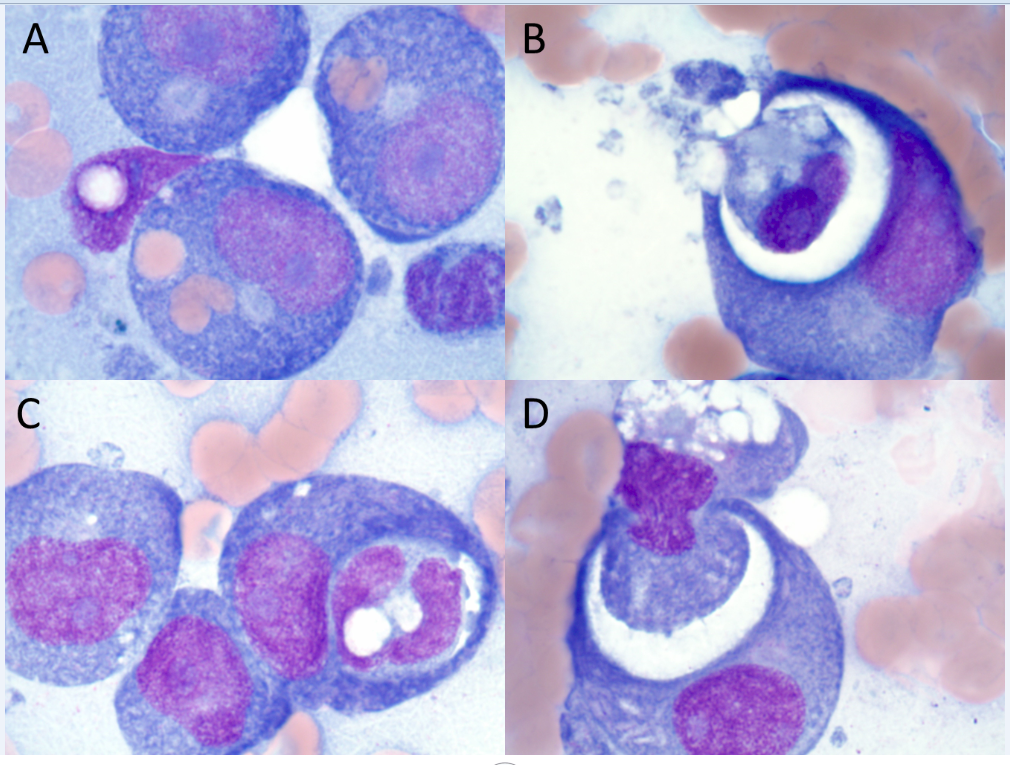 Hemophagocytosis in Acute Myeloid Leukemia