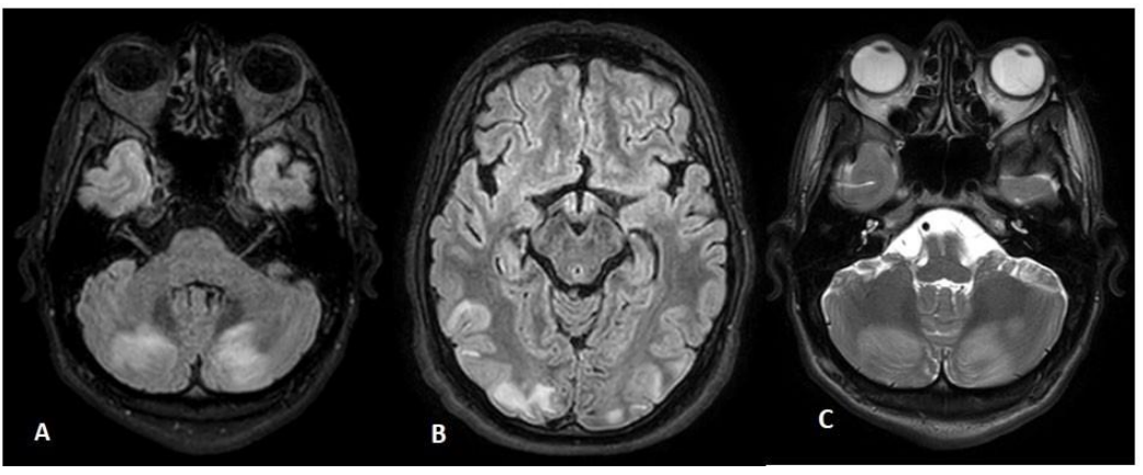 Press Syndrome: An Unusual Complication of Chemotherapy