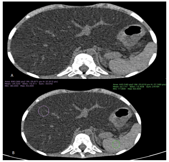 Hepatic Steatosis: Non-Enhanced CT