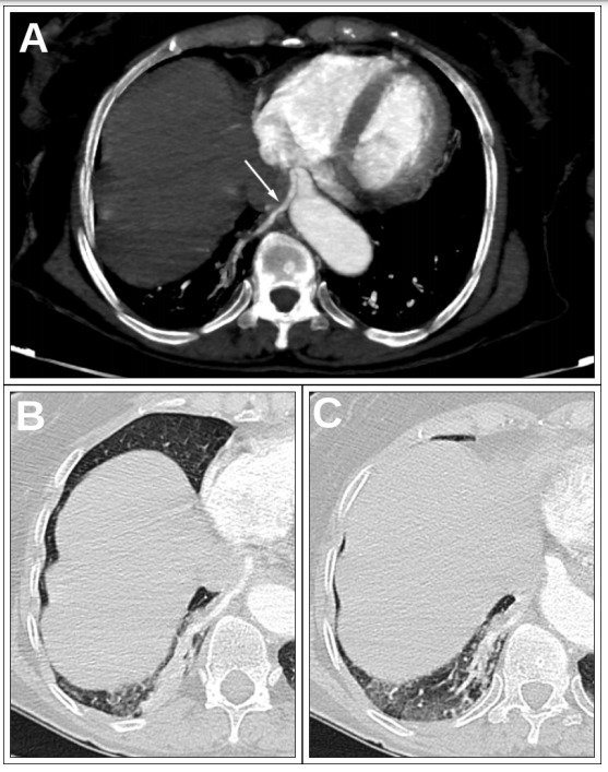 Pulmonary Sequestration: The Feeding Vessel