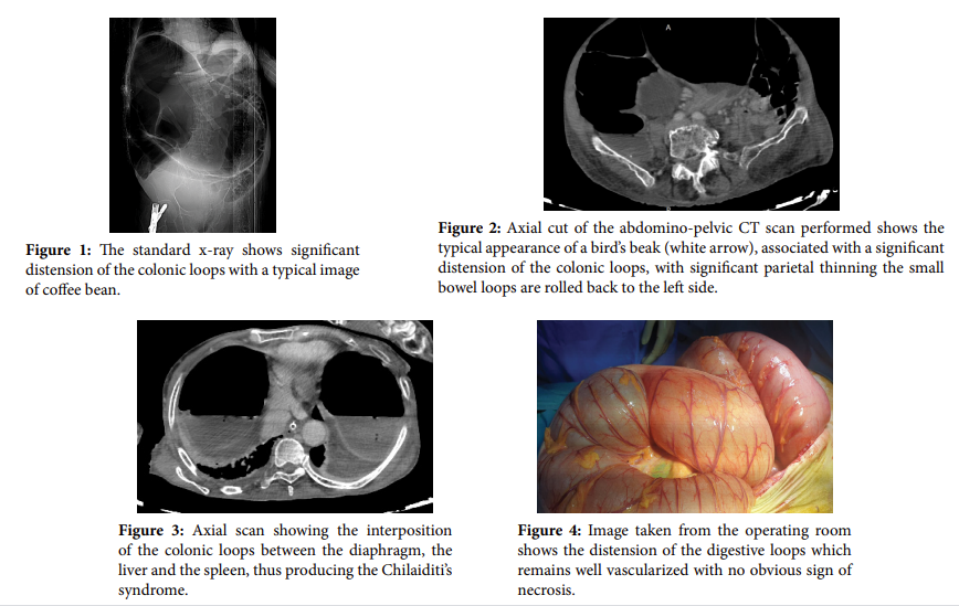 A Very rare case of synchronous volvulus of the transverse colon and sigmoid causing large-bowel obstruction
