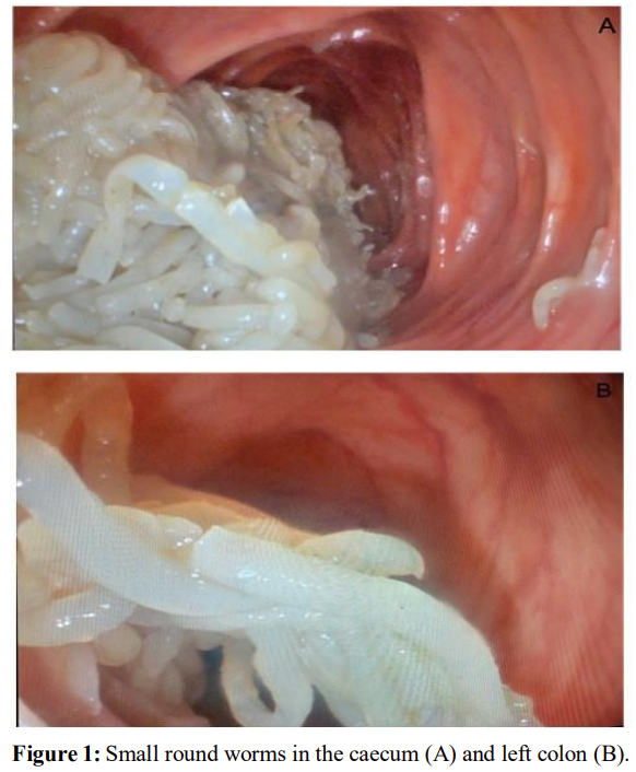 An Endoscopic Lure: When Healthy Diet Mistakes Infection