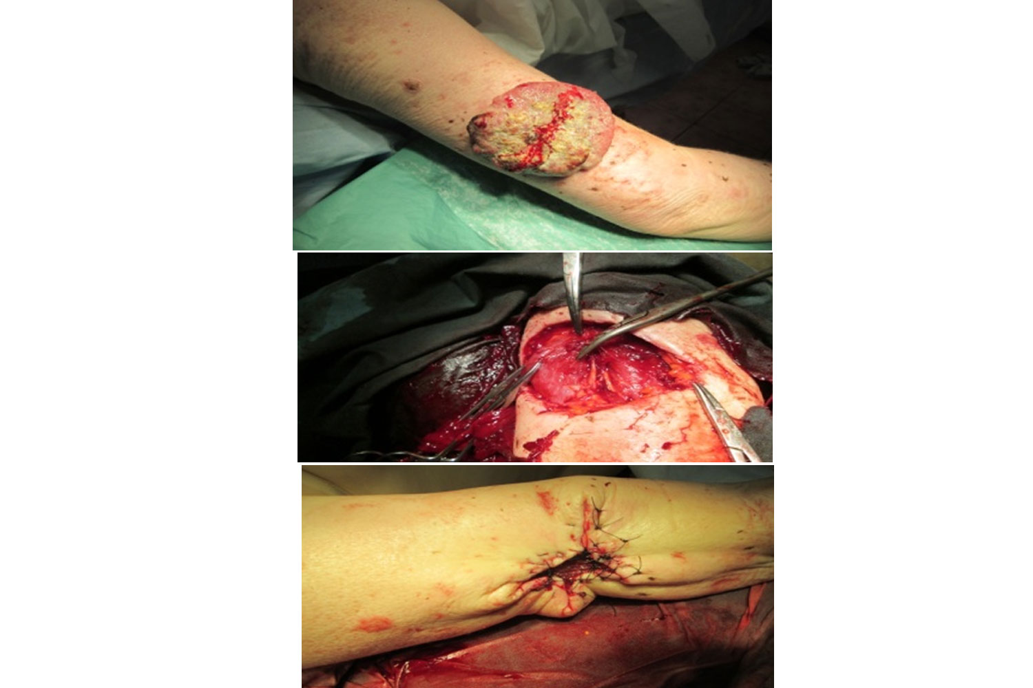 Squamous Cell Carcinoma in an Albino