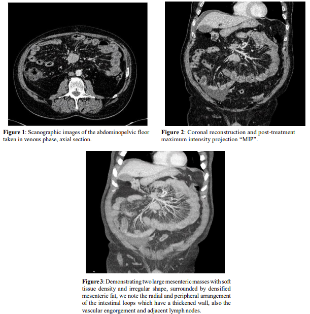 Spoke Wheel Sign of the Mesenteric Carcinoid Tumor