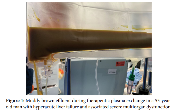 Unusual Plasma Colour in Acute Liver Failure