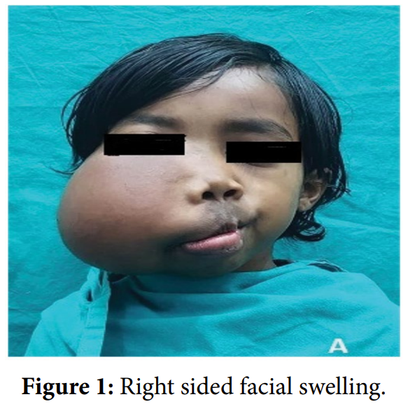 Congenital Infiltrating Lipomatosis of the Face