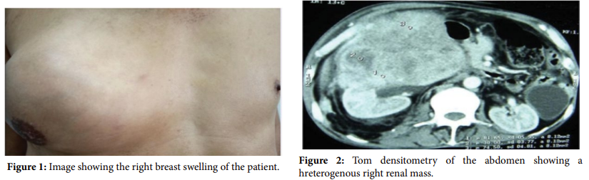Mammary Metastasis of Renal Leiomyosarcoma