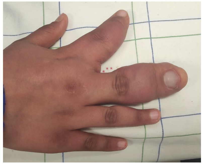 Unusual Cause of Macrodactyly