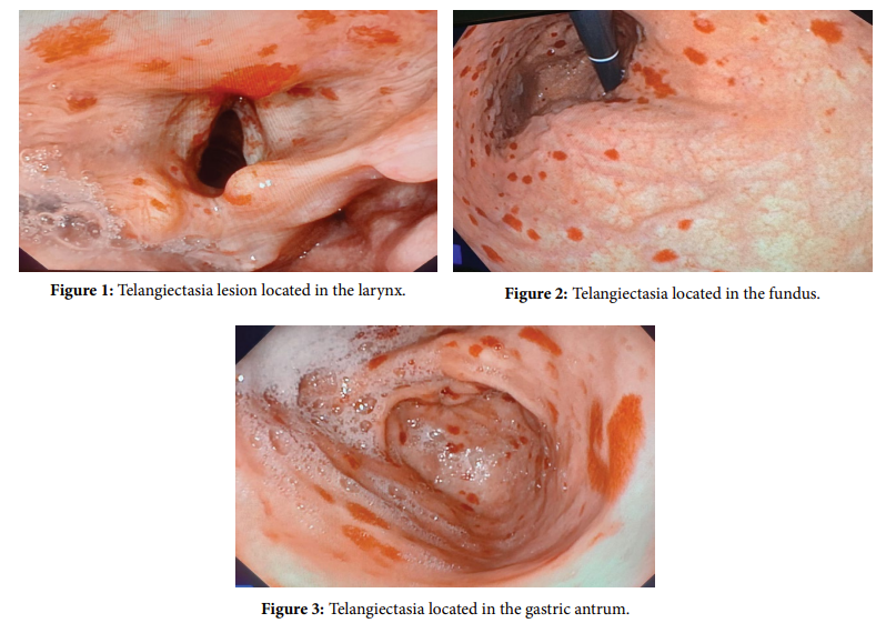 A Rare Case of Upper Gastrointestinal Bleeding: Osler-Weber-Rendu Syndrome.