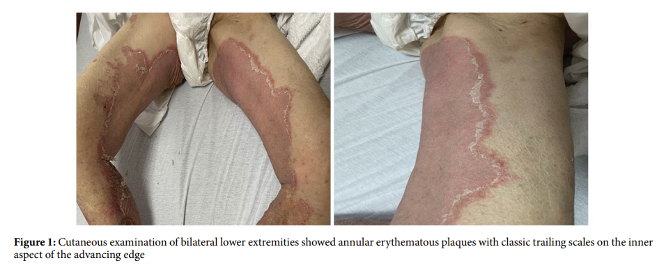 Figurate Erythema