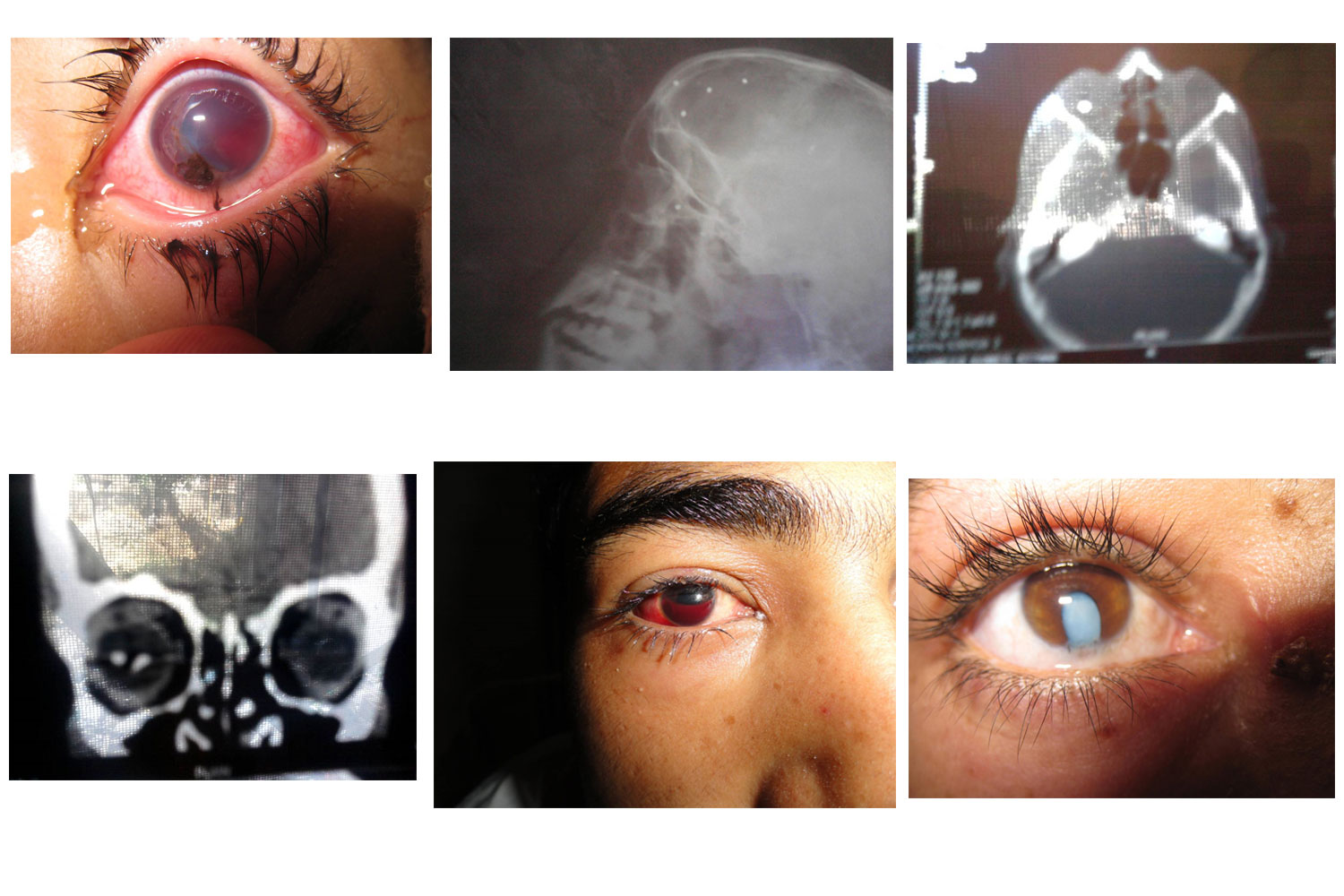 Pellet Gun Injury